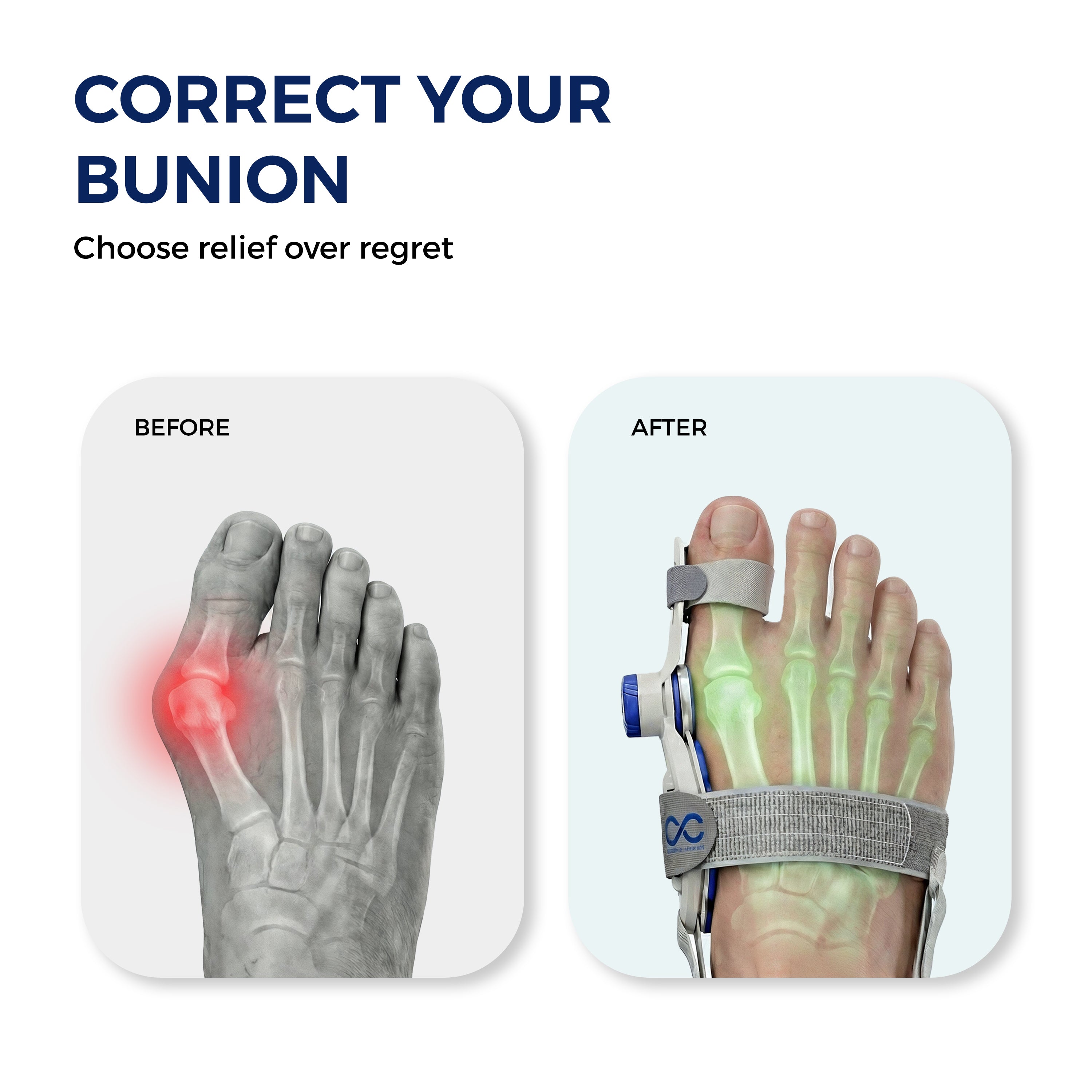 Cozyva Toe Alignment Sleeve – Flexible Foot Support