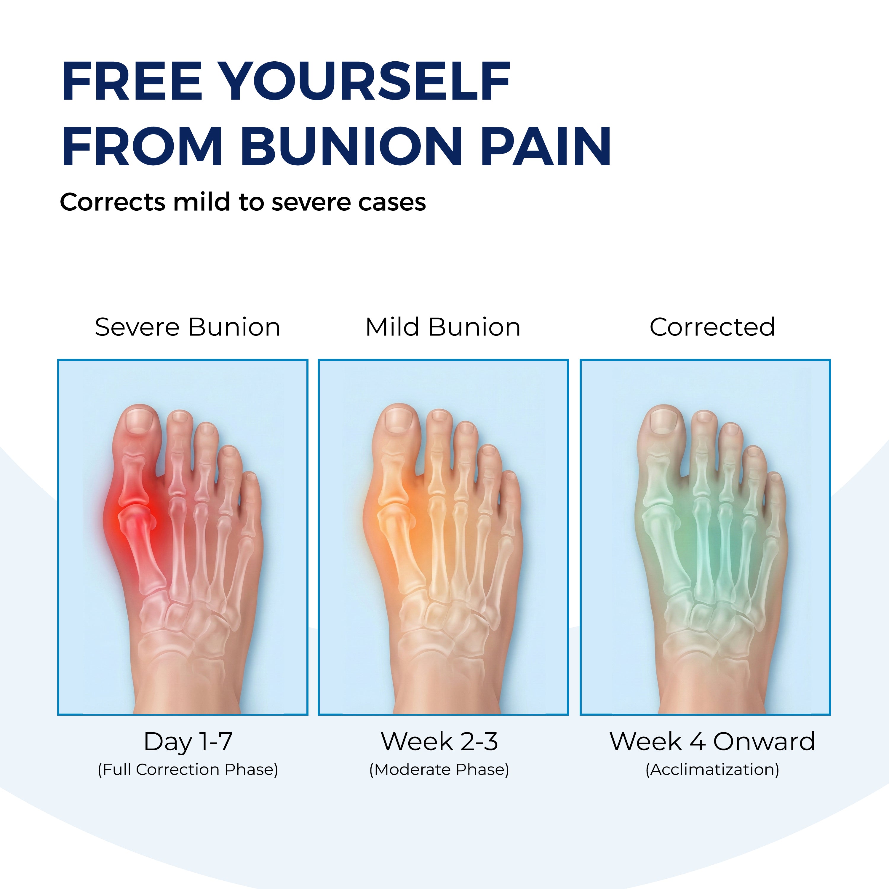 Cozyva Toe Alignment Sleeve – Flexible Foot Support