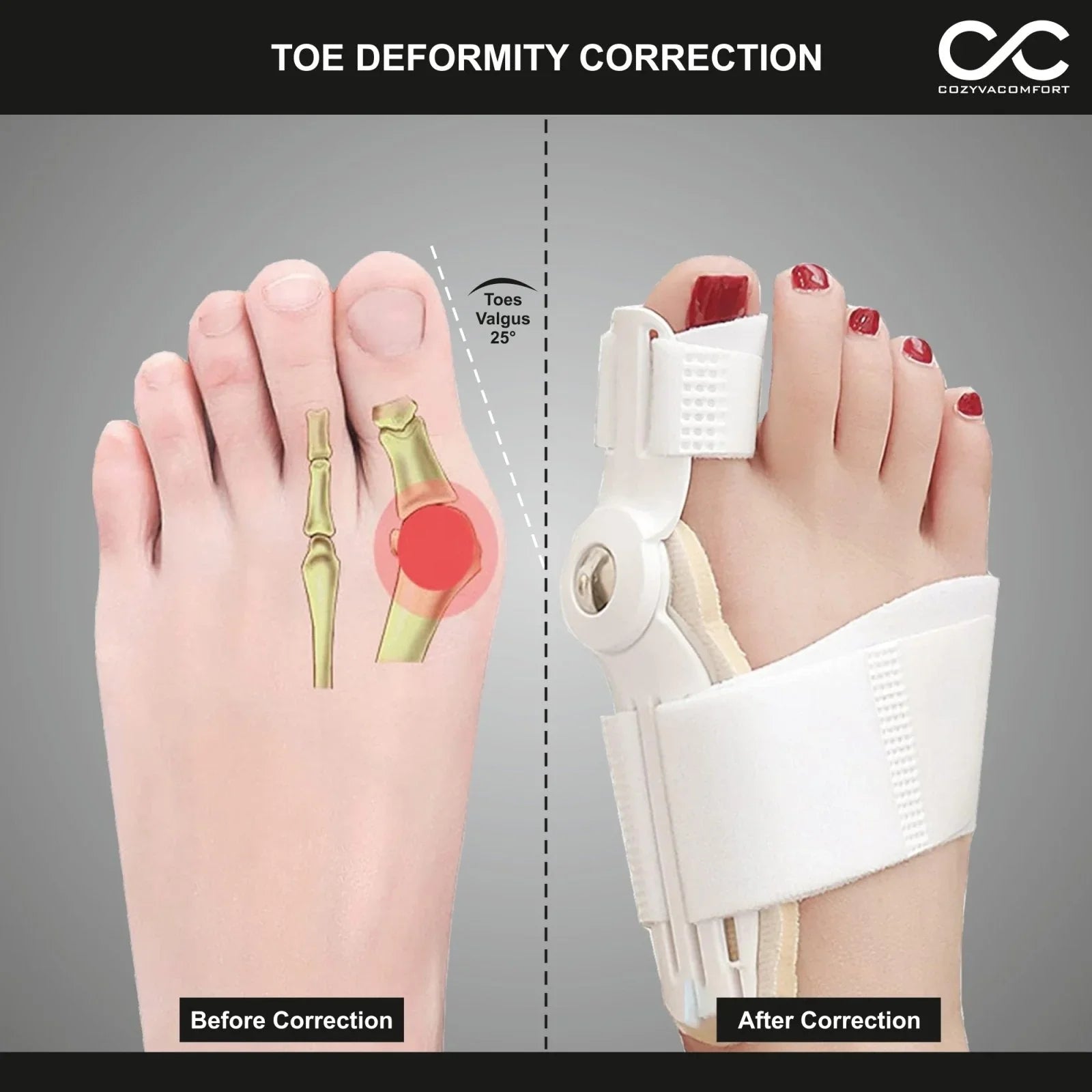 Thumb Straightener - Cozyva Comfort