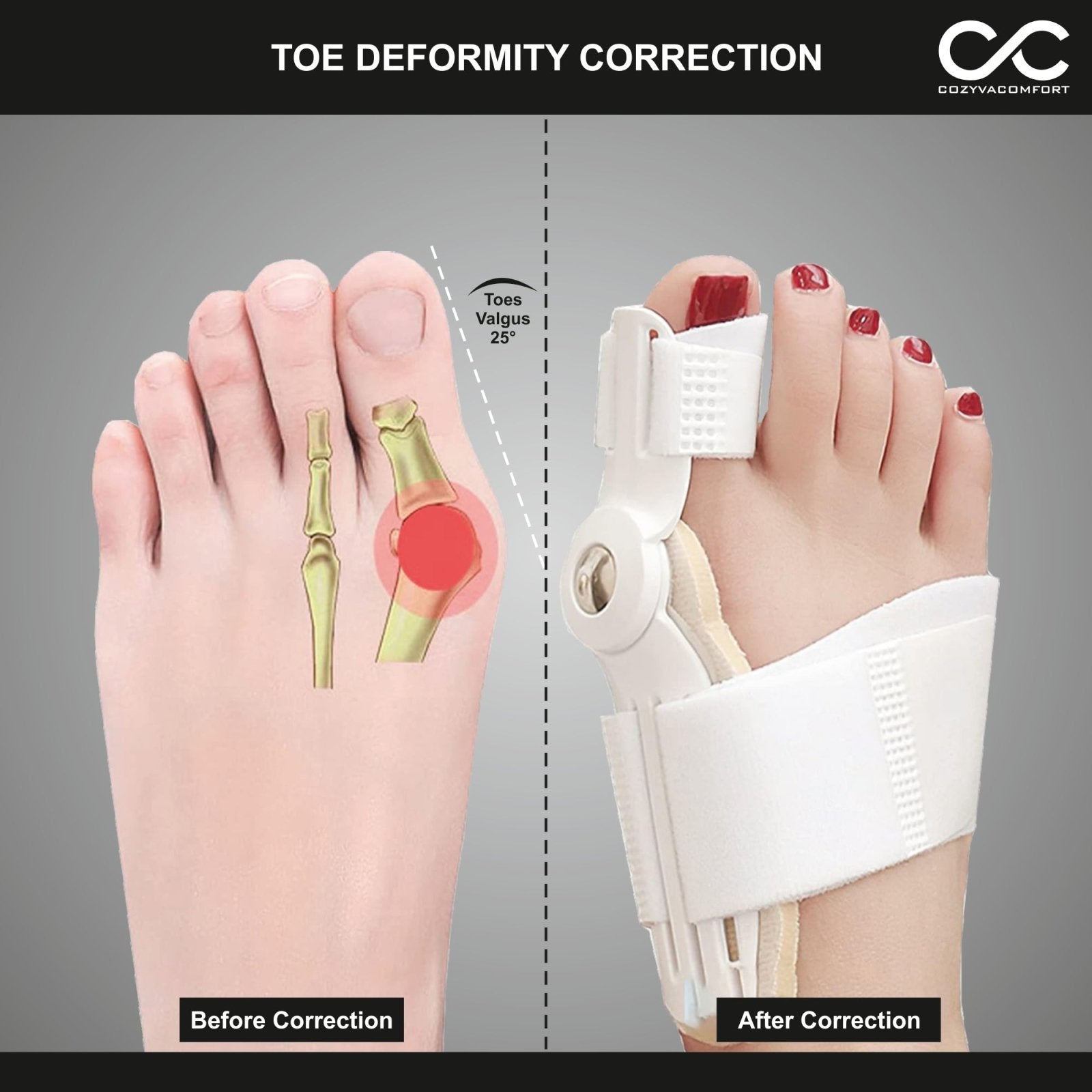 Thumb Straightener - Cozyva Comfort